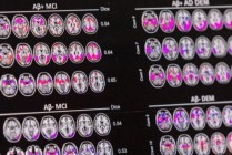 数十万元阿尔茨海默病疗法纳入首版商保创新药目录，离进医保还远吗